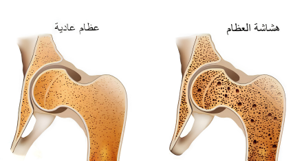 اعراض هشاشة العظام عند النساء