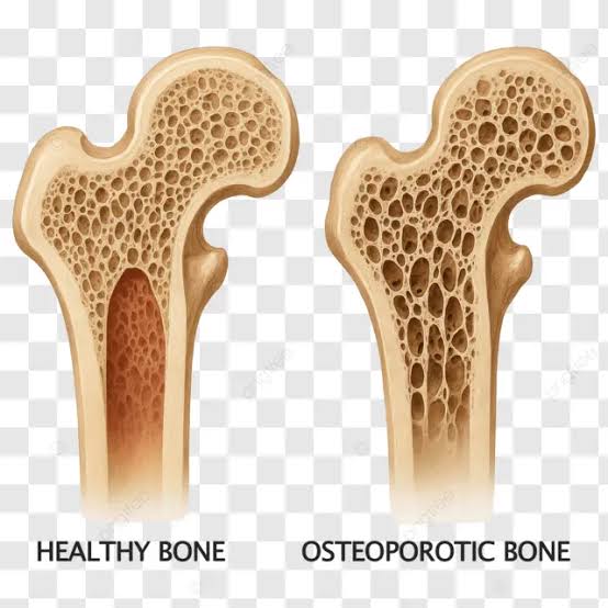 هشاشة العظام (Osteoporosis)