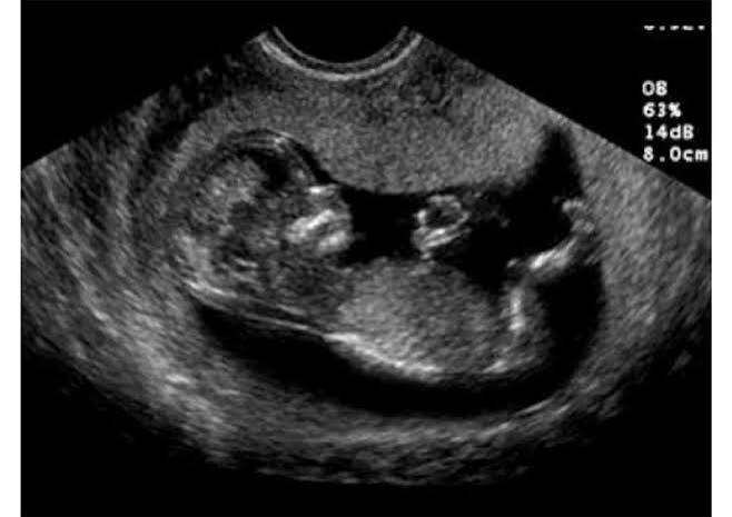 سونار الحمل بولد: متى يظهر الجنين الذكر بوضوح؟ وما مدى دقة النتيجة؟